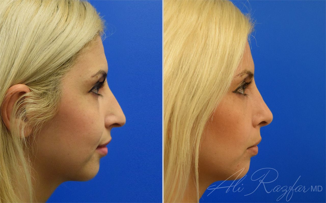 Rhinoplasty Before & After