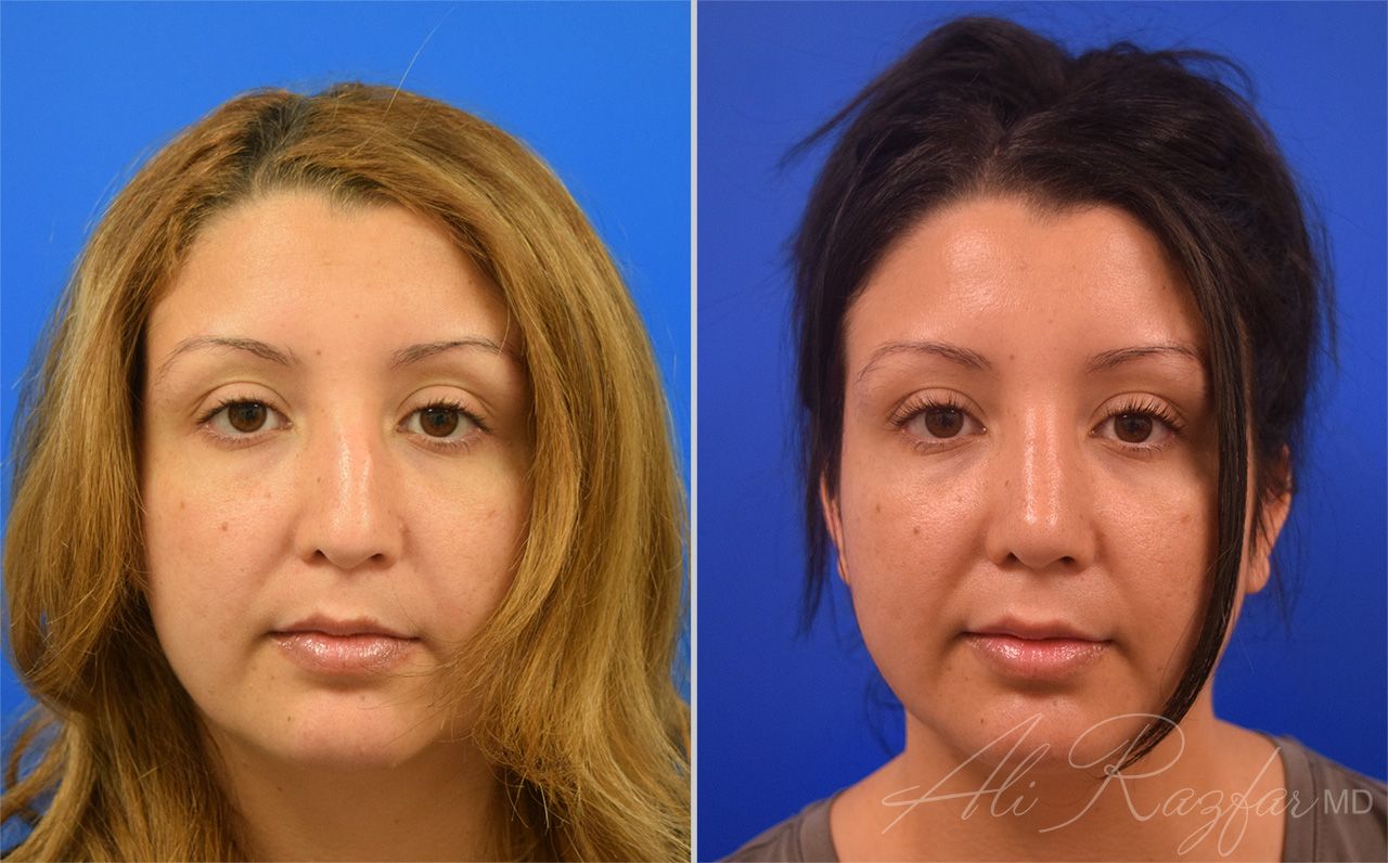 Rhinoplasty Before & After