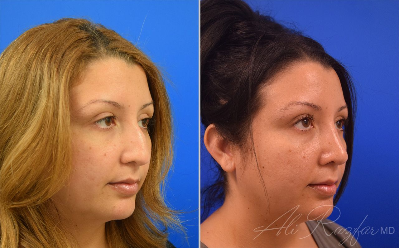Rhinoplasty Before & After