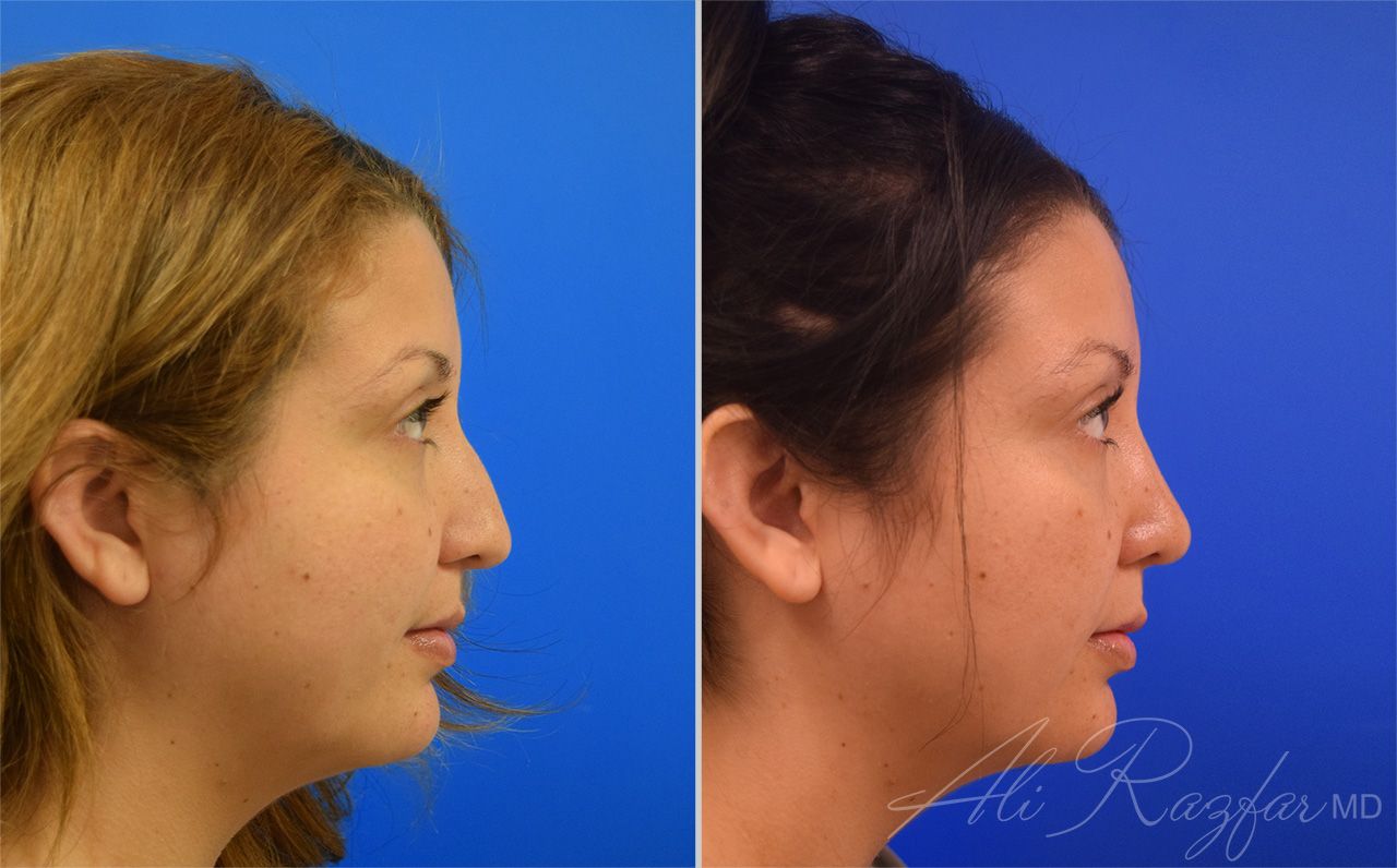 Rhinoplasty Before & After