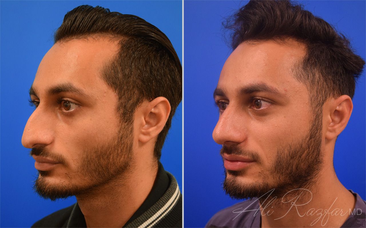 Rhinoplasty Before & After