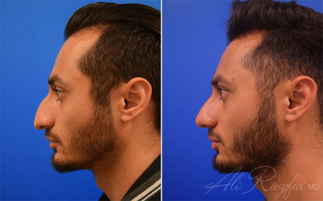 Rhinoplasty Before & After