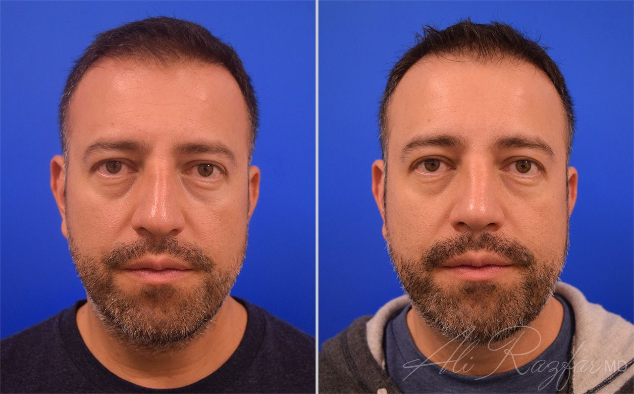 Rhinoplasty Before & After