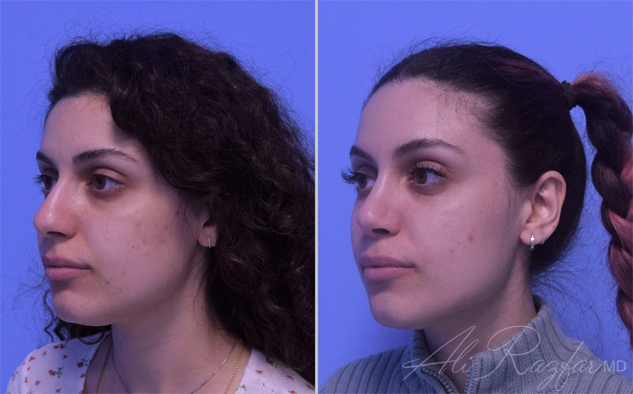 Rhinoplasty Before & After
