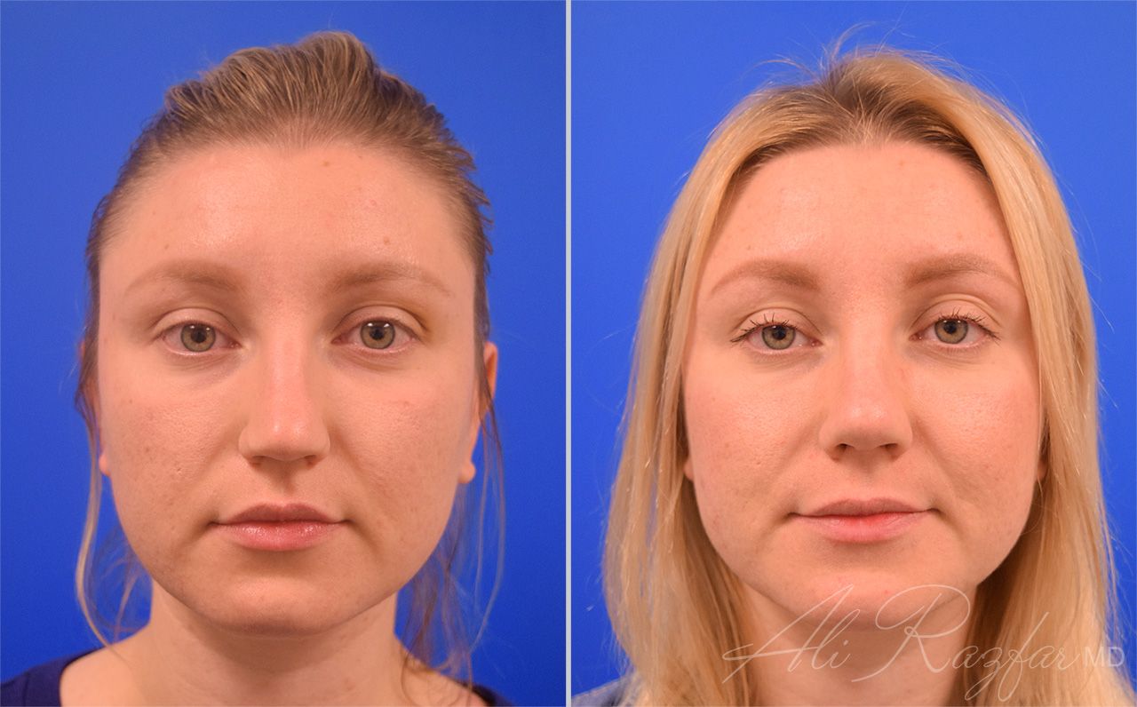 Rhinoplasty Before & After