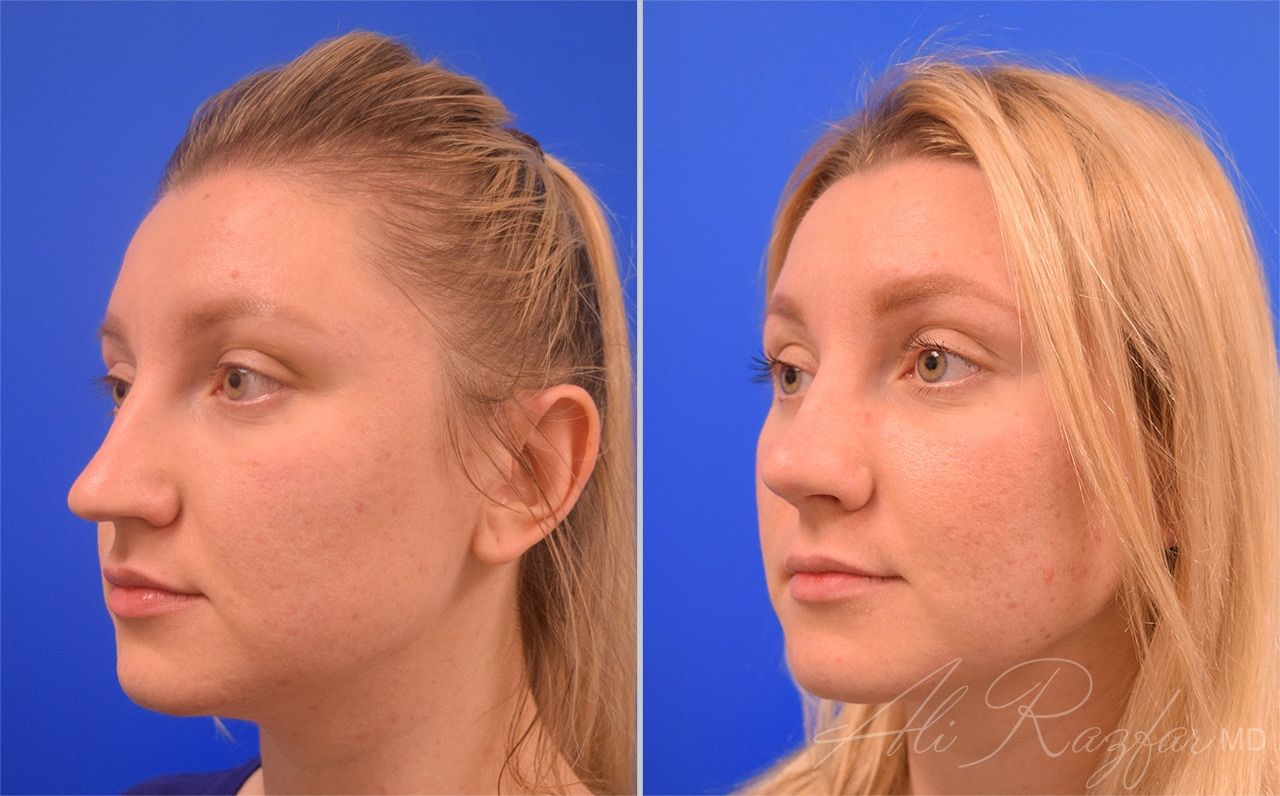 Rhinoplasty Before & After