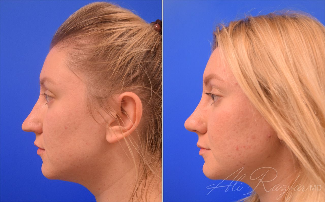 Rhinoplasty Before & After