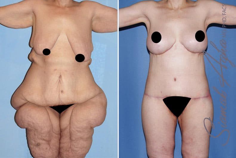 Total Body Lift Before & After