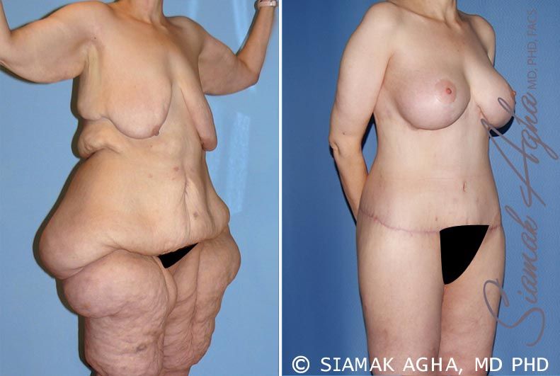 Total Body Lift Before & After