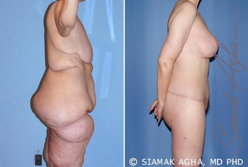 Total Body Lift Before & After