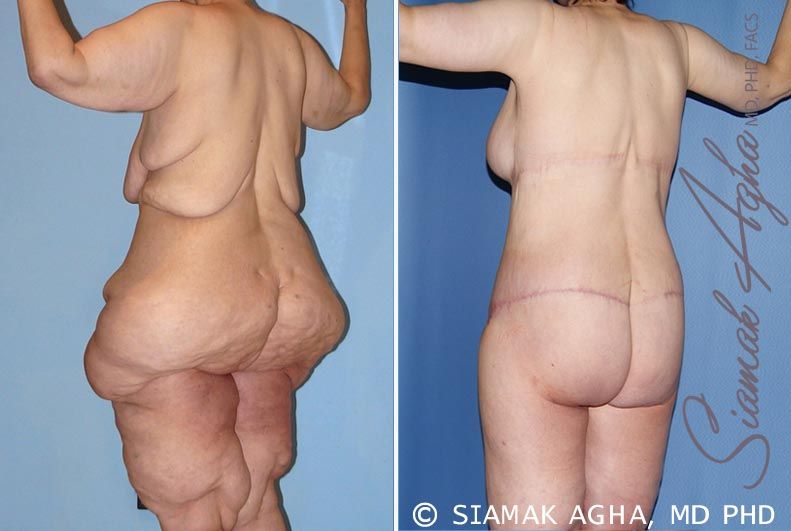 Total Body Lift Before & After