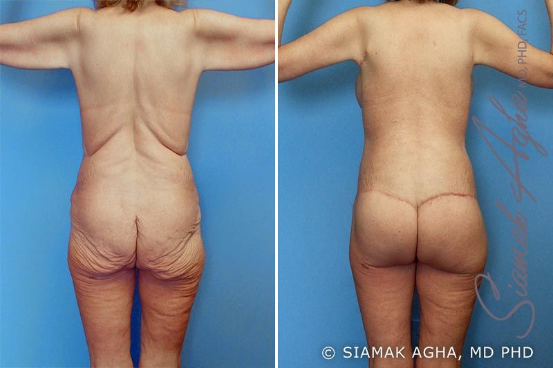 Total Body Lift Before & After