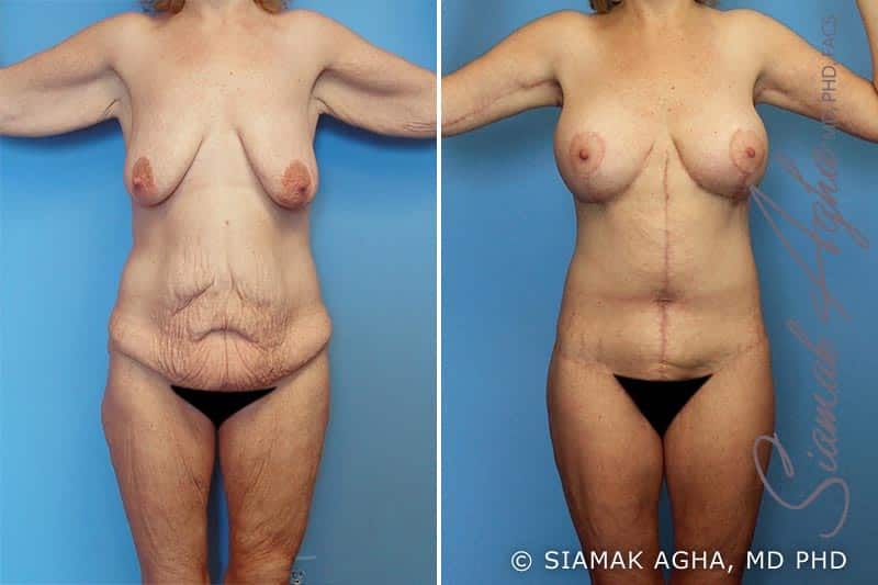 Total Body Lift Before & After