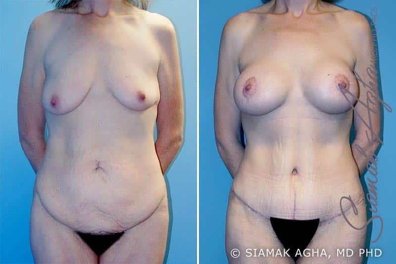 Total Body Lift Before & After