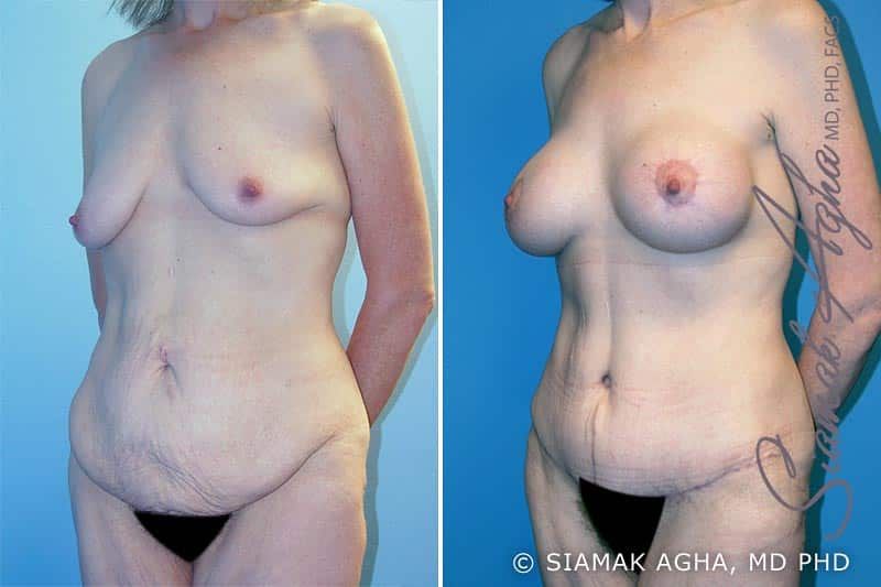 Total Body Lift Before & After