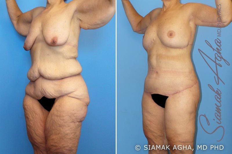 Total Body Lift Before & After
