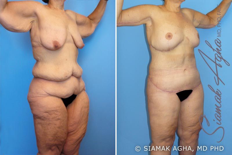 Total Body Lift Before & After
