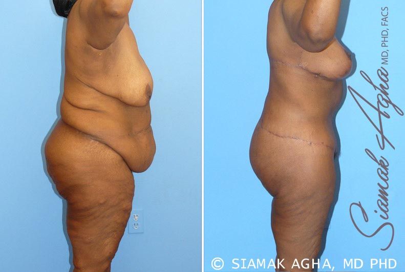 Total Body Lift Before & After