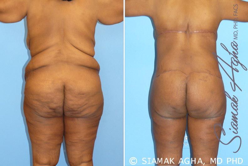 Total Body Lift Before & After