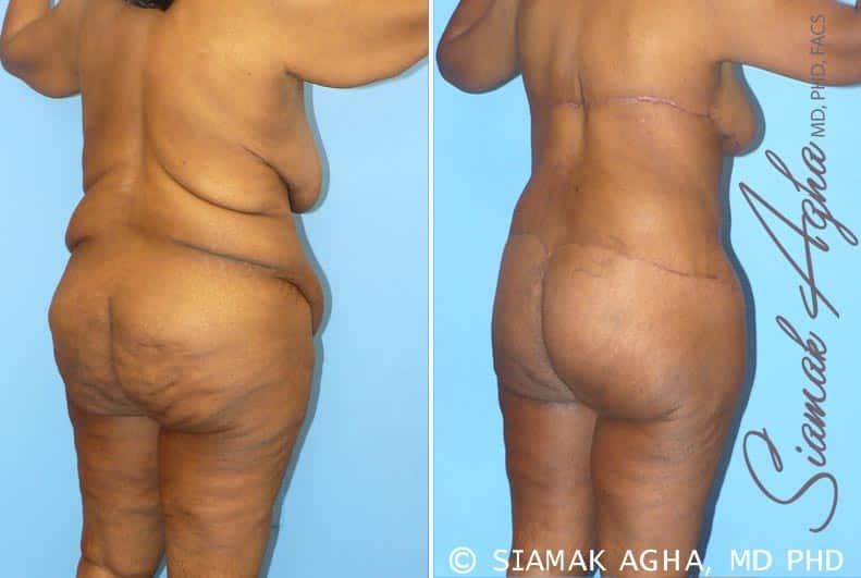Total Body Lift Before & After