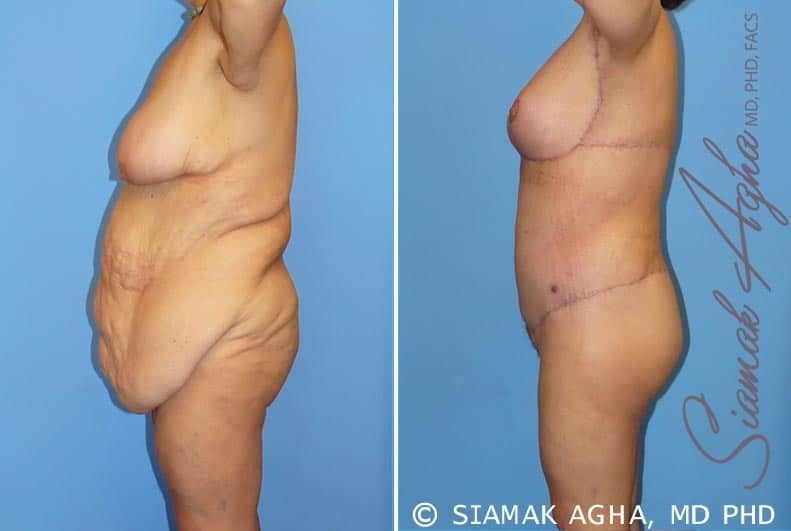 Total Body Lift Before & After