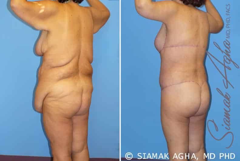 Total Body Lift Before & After
