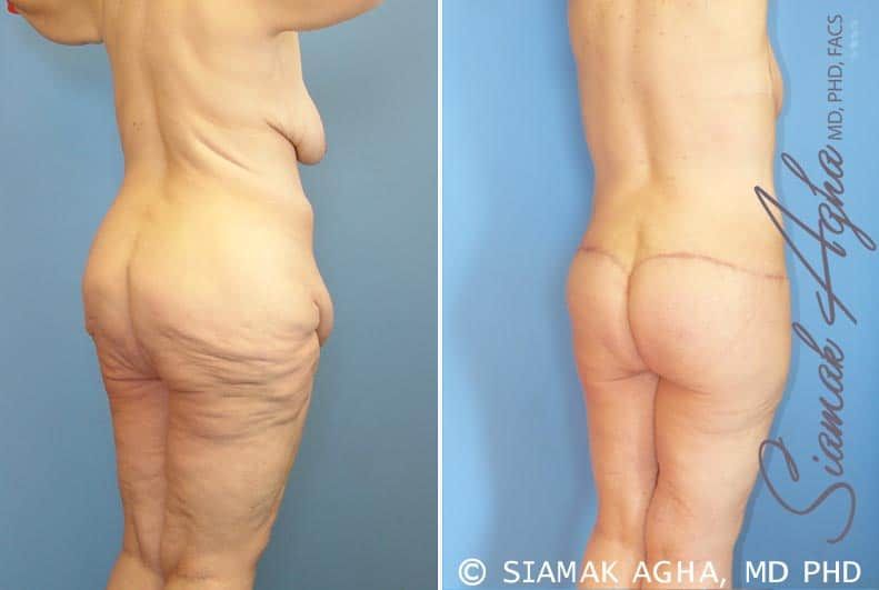 Total Body Lift Before & After