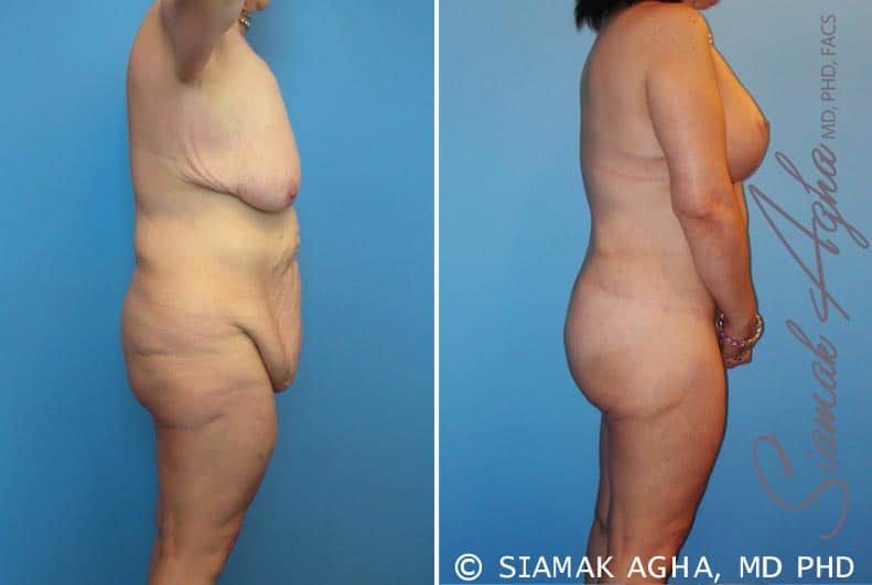 Total Body Lift Before & After