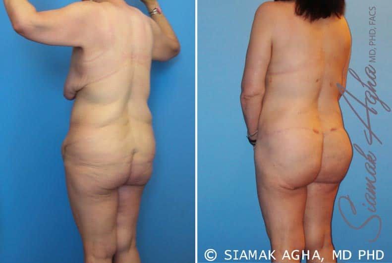 Total Body Lift Before & After