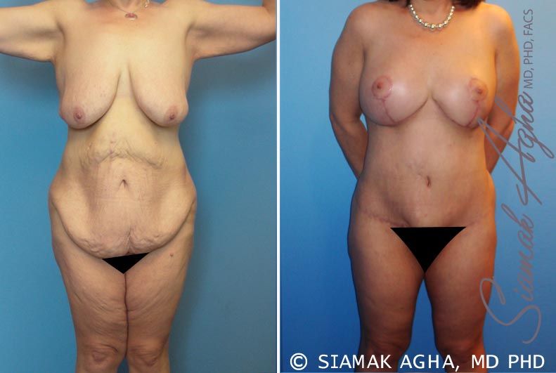 Total Body Lift Before & After