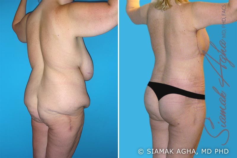 Total Body Lift Before & After