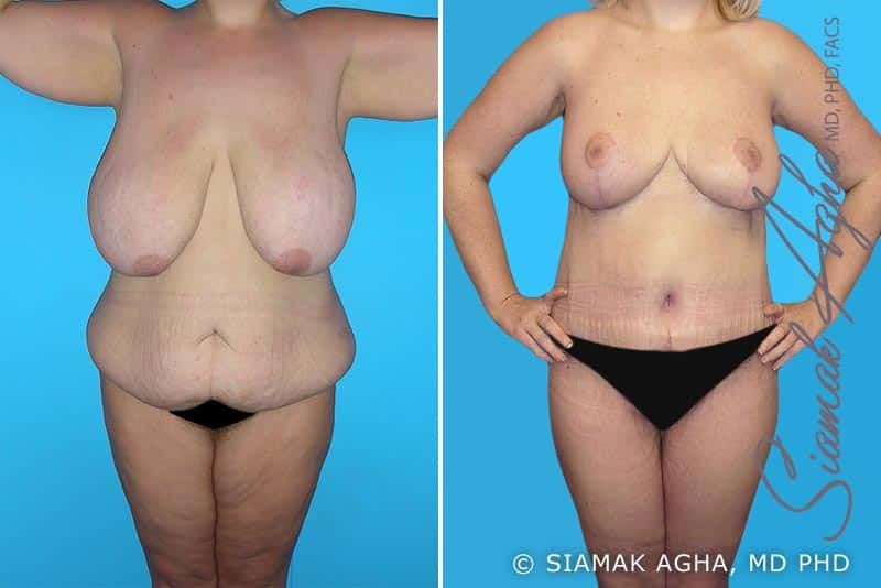 Total Body Lift Before & After