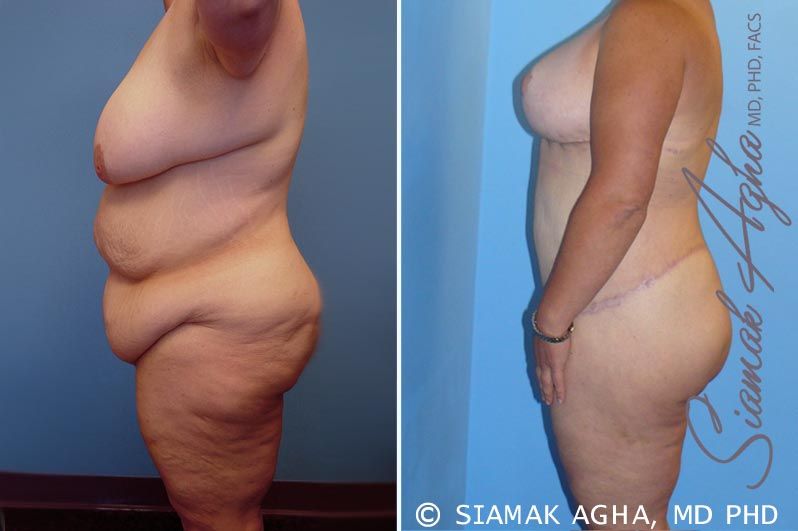 Total Body Lift Before & After