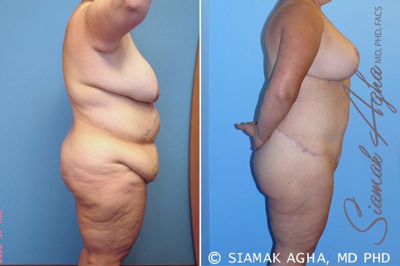 Total Body Lift Before & After