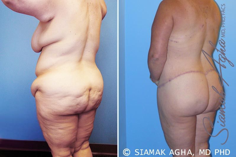 Total Body Lift Before & After