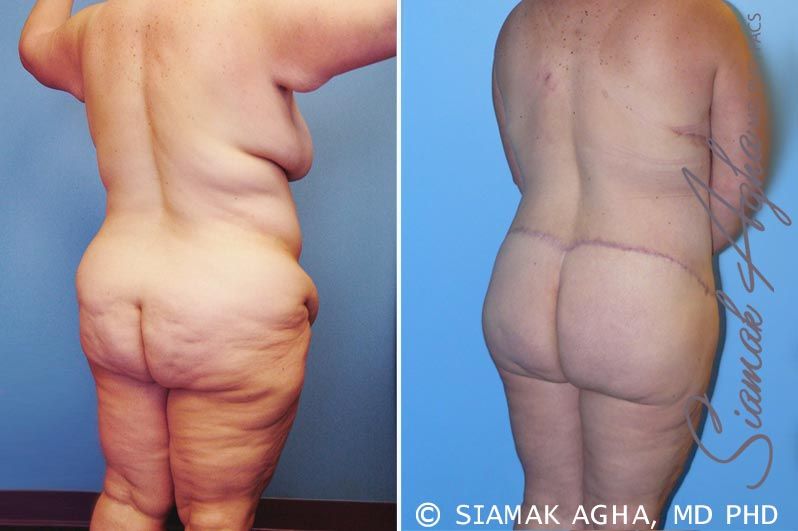 Total Body Lift Before & After