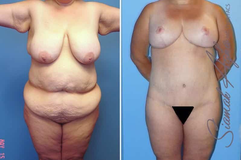 Total Body Lift Before & After