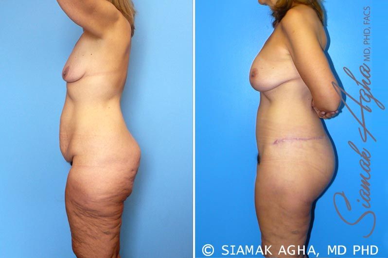 Total Body Lift Before & After