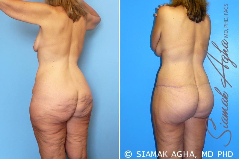 Total Body Lift Before & After