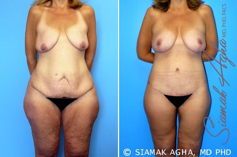 Total Body Lift Before & After