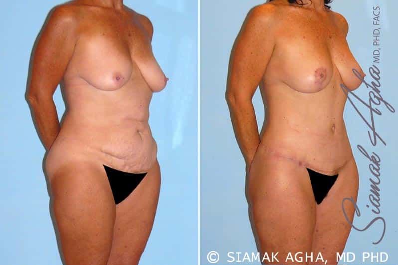 Total Body Lift Before & After