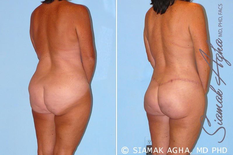 Total Body Lift Before & After