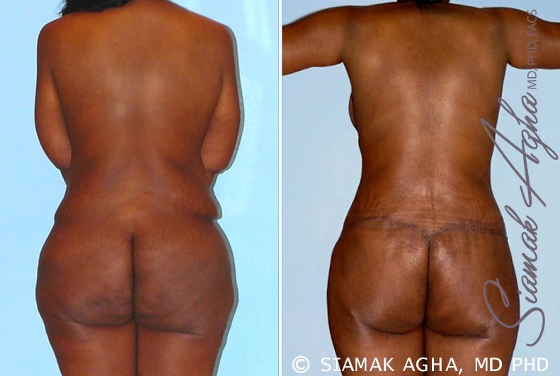 Total Body Lift Before & After