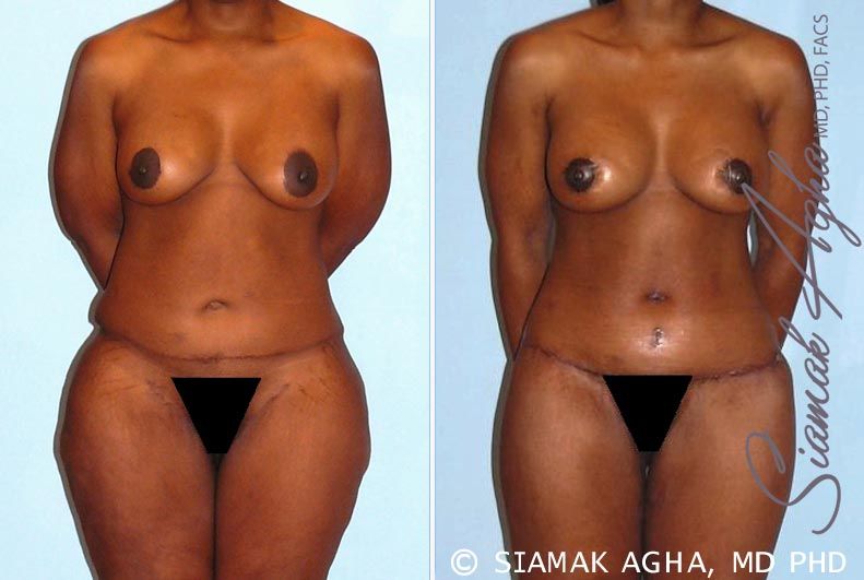 Total Body Lift Before & After