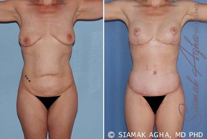 Total Body Lift Before & After