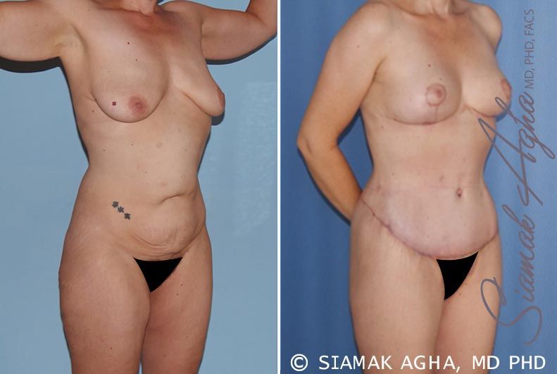 Total Body Lift Before & After