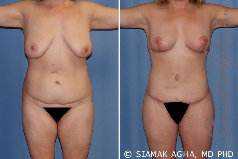 Total Body Lift Before & After