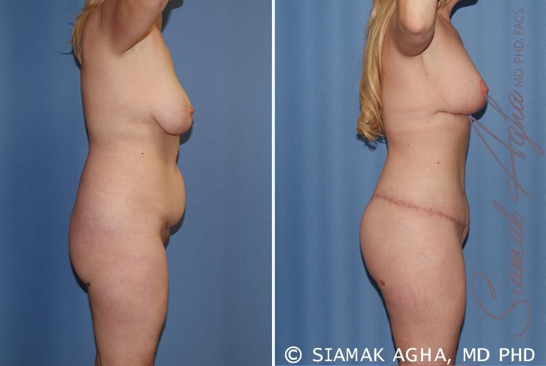 Total Body Lift Before & After