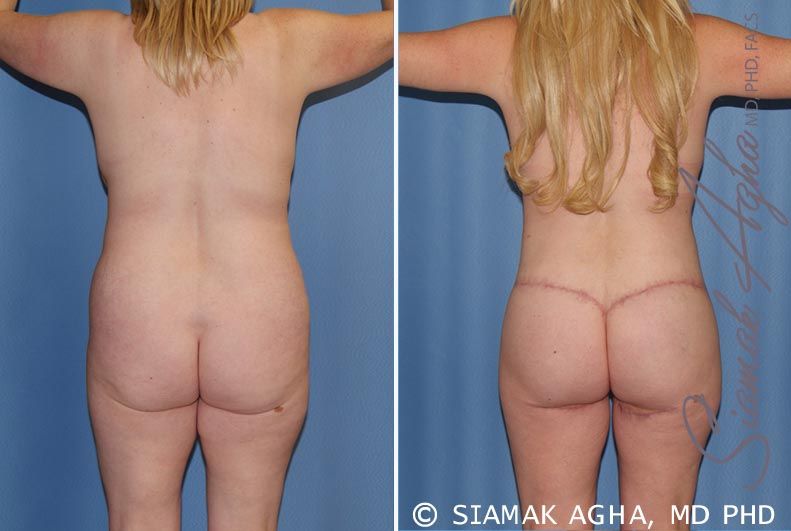 Total Body Lift Before & After