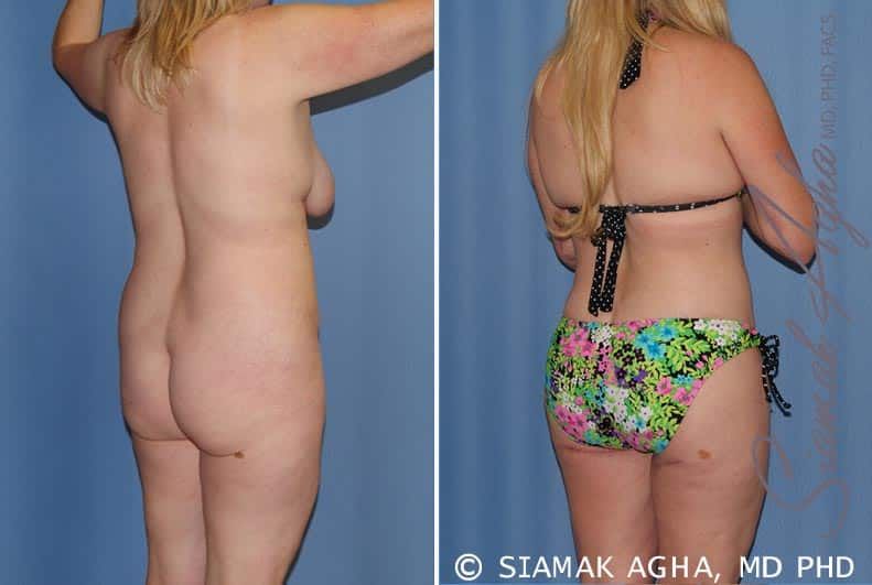 Total Body Lift Before & After